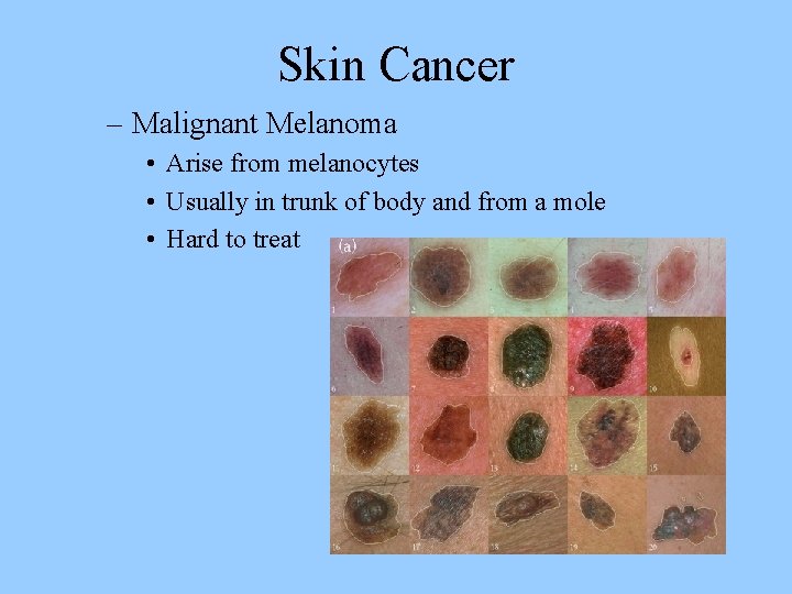 Skin Cancer – Malignant Melanoma • Arise from melanocytes • Usually in trunk of