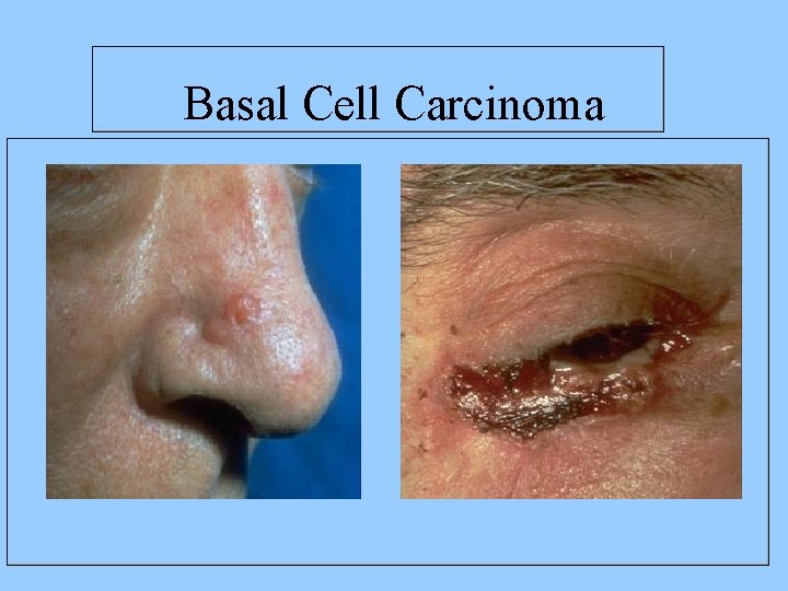  Basal Cell Carcinoma 