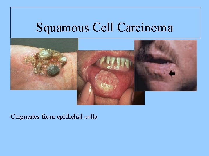  Squamous Cell Carcinoma Originates from epithelial cells 
