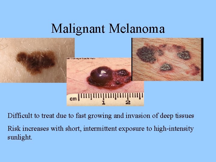 Malignant Melanoma Difficult to treat due to fast growing and invasion of deep tissues