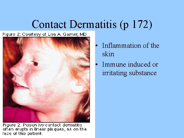 Contact Dermatitis (p 172) • Inflammation of the skin • Immune induced or irritating