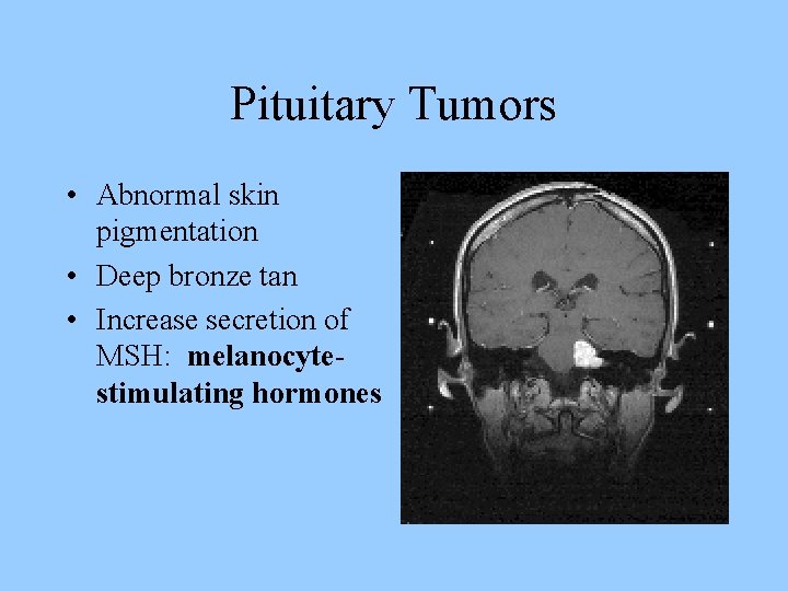Pituitary Tumors • Abnormal skin pigmentation • Deep bronze tan • Increase secretion of