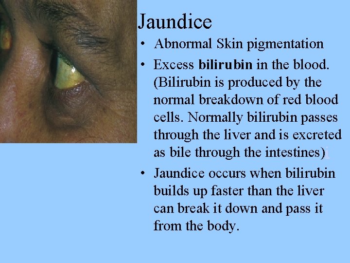 Jaundice • Abnormal Skin pigmentation • Excess bilirubin in the blood. (Bilirubin is produced