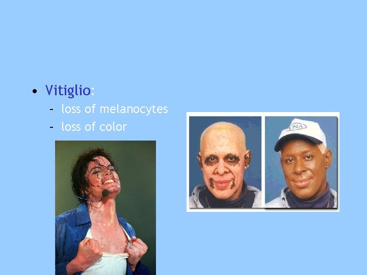 • Vitiglio: – loss of melanocytes – loss of color 