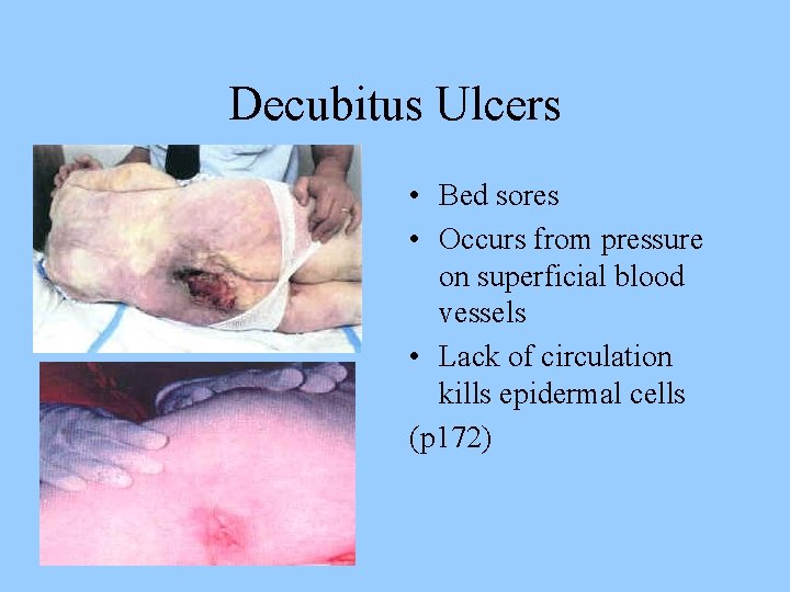 Decubitus Ulcers • Bed sores • Occurs from pressure on superficial blood vessels •
