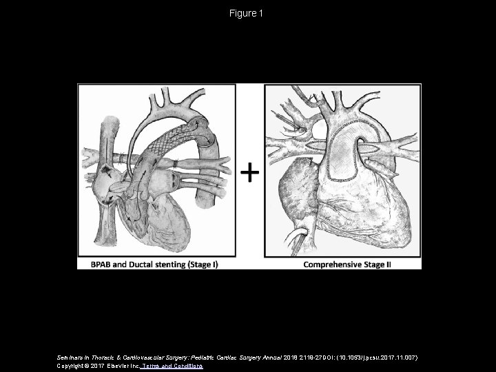 Figure 1 Seminars in Thoracic & Cardiovascular Surgery: Pediatric Cardiac Surgery Annual 2018 2119 -27 Figure 1 Seminars in Thoracic & Cardiovascular Surgery: Pediatric Cardiac Surgery Annual 2018 2119 -27