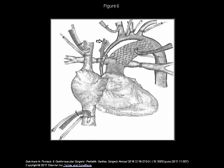 Figure 6 Seminars in Thoracic & Cardiovascular Surgery: Pediatric Cardiac Surgery Annual 2018 2119 -27 Figure 6 Seminars in Thoracic & Cardiovascular Surgery: Pediatric Cardiac Surgery Annual 2018 2119 -27