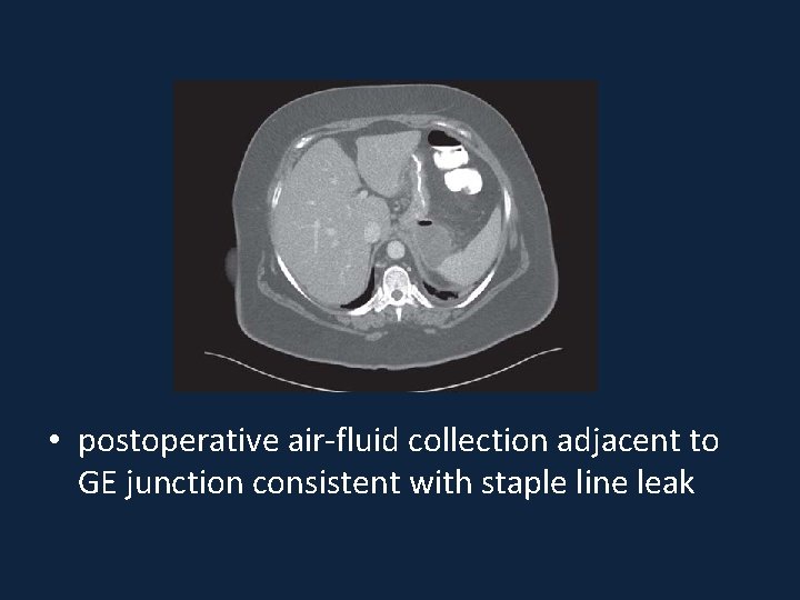  • postoperative air-fluid collection adjacent to GE junction consistent with staple line leak