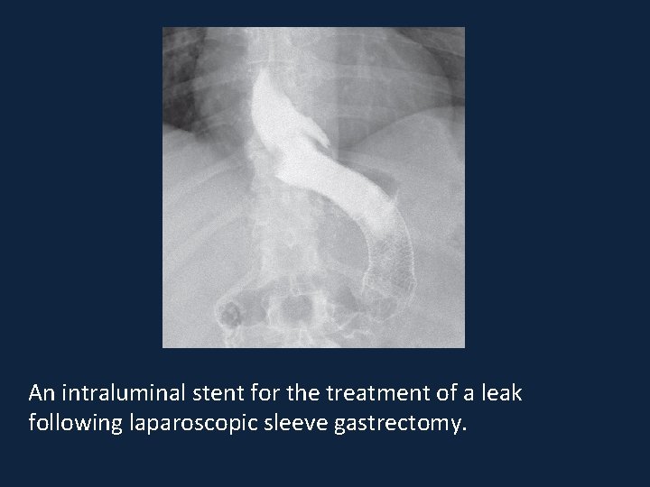 An intraluminal stent for the treatment of a leak following laparoscopic sleeve gastrectomy. 