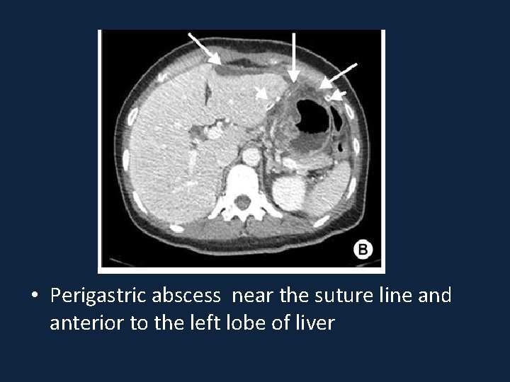  • Perigastric abscess near the suture line and anterior to the left lobe