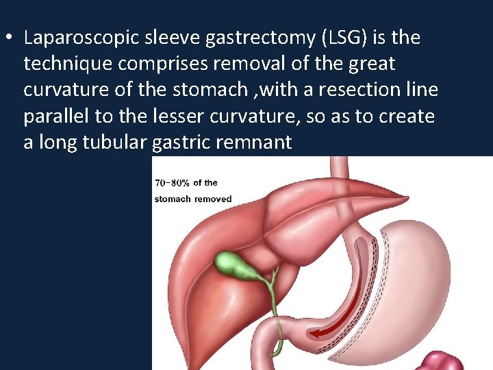  • Laparoscopic sleeve gastrectomy (LSG) is the technique comprises removal of the great