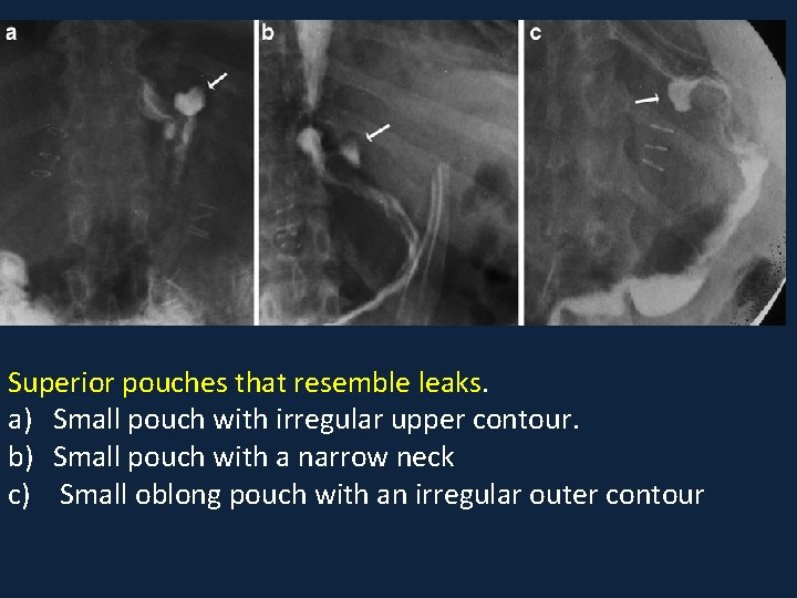 Superior pouches that resemble leaks. a) Small pouch with irregular upper contour. b) Small