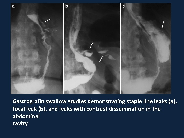 Gastrografin swallow studies demonstrating staple line leaks (a), focal leak (b), and leaks with