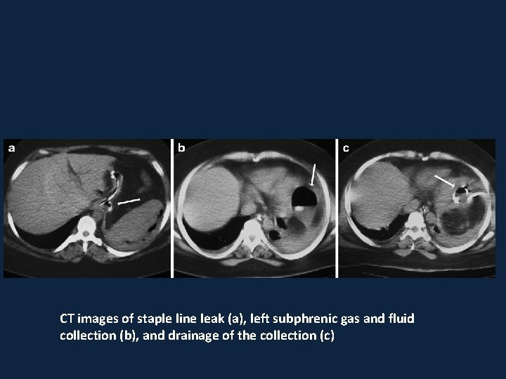 CT images of staple line leak (a), left subphrenic gas and fluid collection (b),