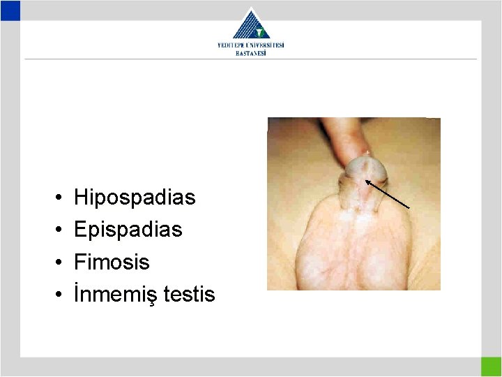  • • Hipospadias Epispadias Fimosis İnmemiş testis 