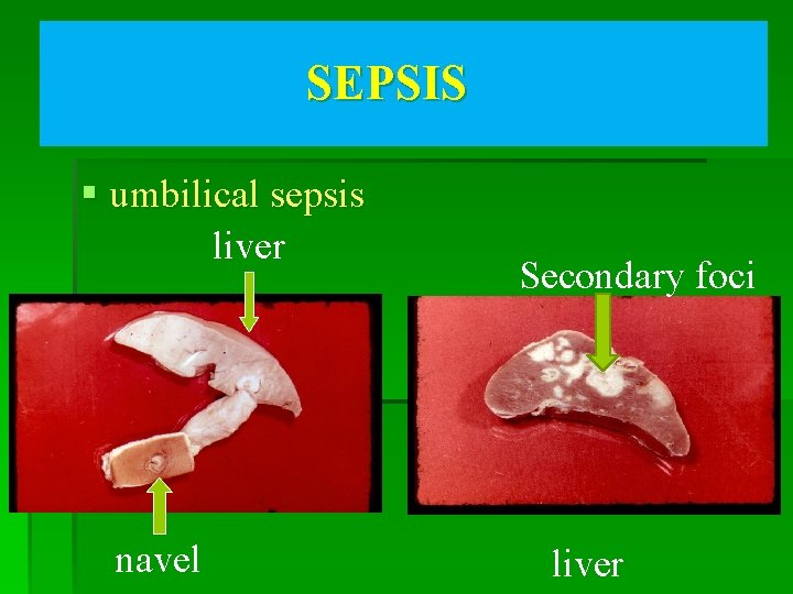 SEPSIS § umbilical sepsis liver navel Secondary foci liver 