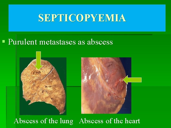 SEPTICOPYEMIA § Purulent metastases as abscess Abscess of the lung Abscess of the heart