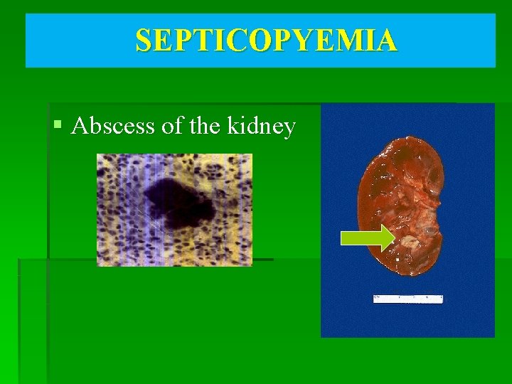 SEPTICOPYEMIA § Abscess of the kidney 