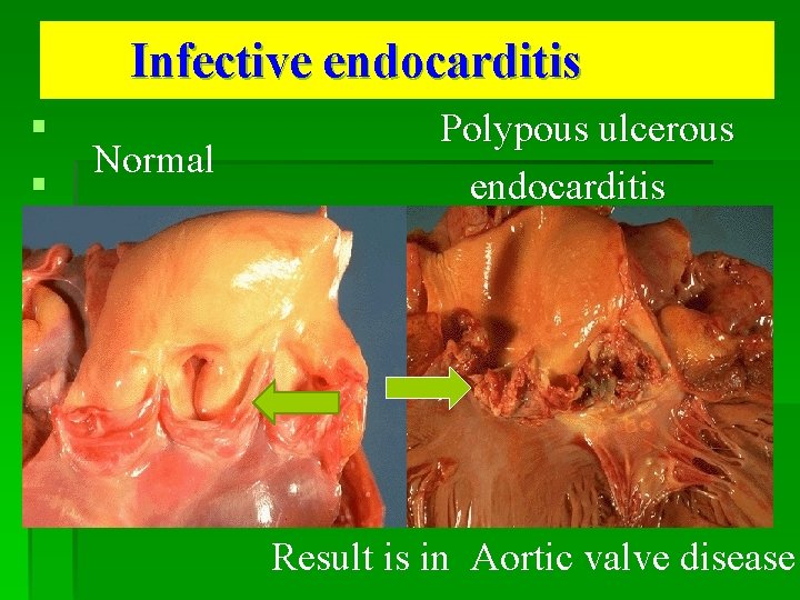 Infective endocarditis § § Normal Polypous ulcerous endocarditis Result is in Aortic valve disease