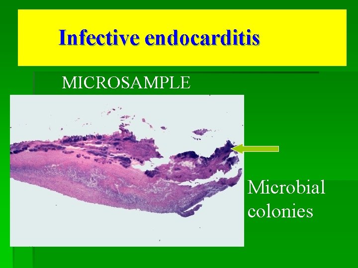 Infective endocarditis MICROSAMPLE Microbial colonies 