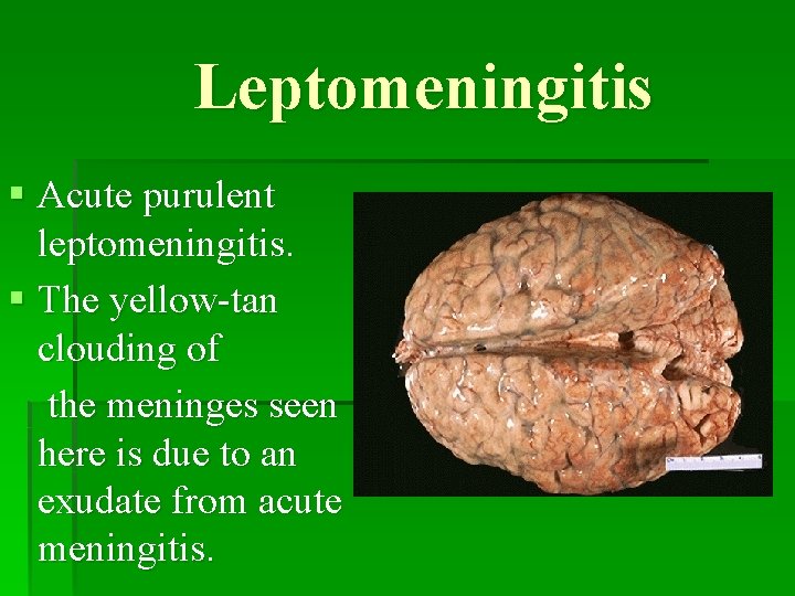 Leptomeningitis § Acute purulent leptomeningitis. § The yellow-tan clouding of the meninges seen here