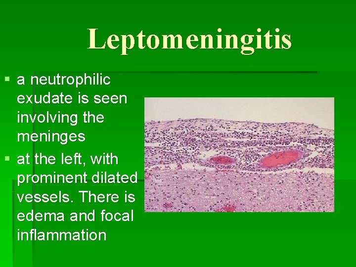 Leptomeningitis § a neutrophilic exudate is seen involving the meninges § at the left,