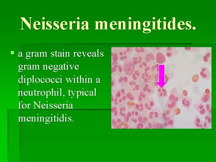 Neisseria meningitides. § a gram stain reveals gram negative diplococci within a neutrophil, typical