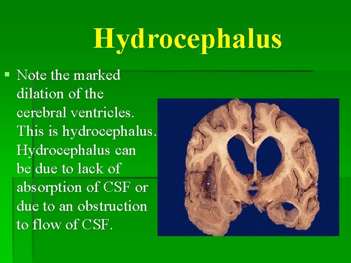 Hydrocephalus § Note the marked dilation of the cerebral ventricles. This is hydrocephalus. Hydrocephalus