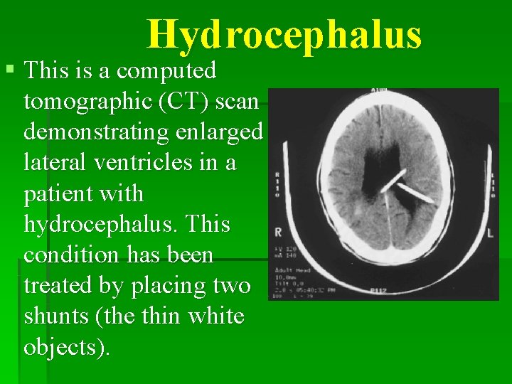 Hydrocephalus § This is a computed tomographic (CT) scan demonstrating enlarged lateral ventricles in