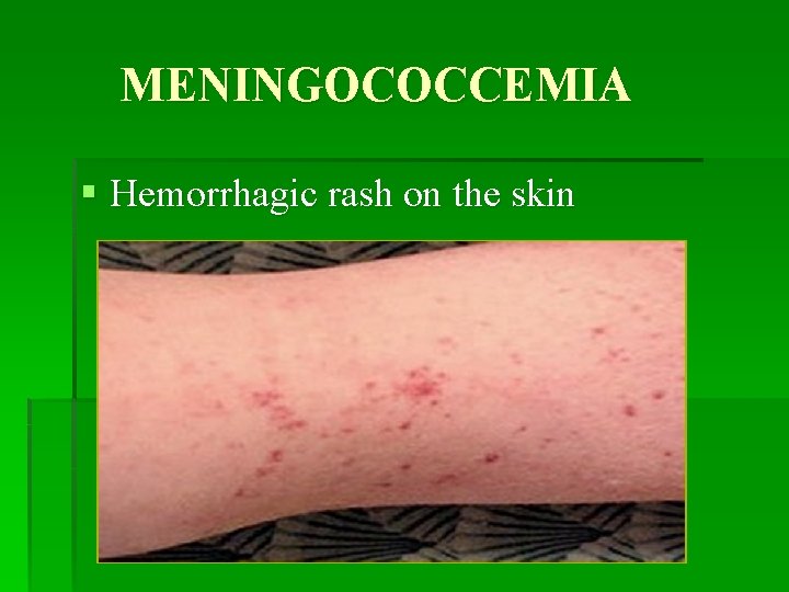MENINGOCOCCEMIA § Hemorrhagic rash on the skin 