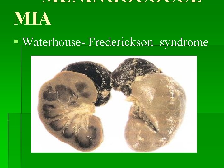 MENINGOCOCCE MIA § Waterhouse- Frederickson syndrome 