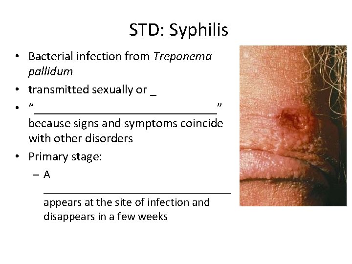 STD: Syphilis • Bacterial infection from Treponema pallidum • transmitted sexually or _ •