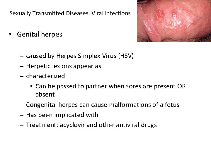 Sexually Transmitted Diseases: Viral Infections • Genital herpes – caused by Herpes Simplex Virus