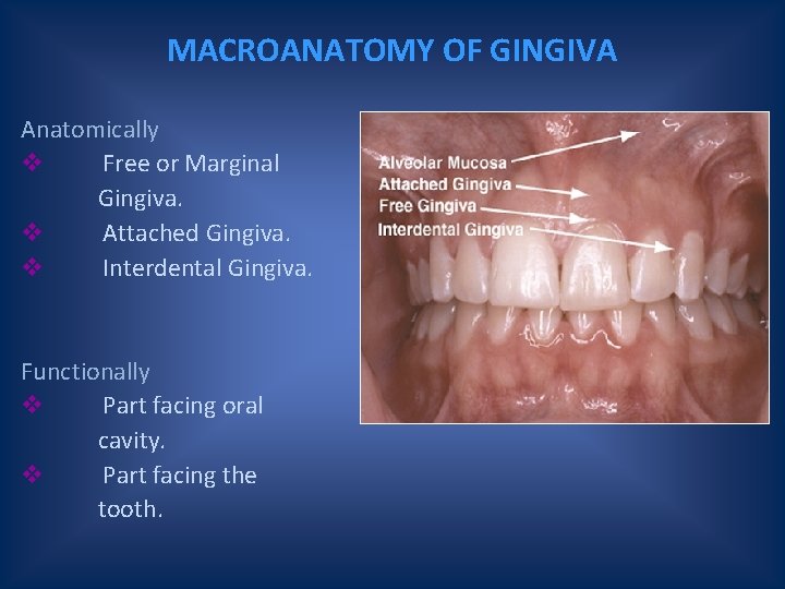 MACROANATOMY OF GINGIVA Anatomically v Free or Marginal Gingiva. v Attached Gingiva. v Interdental