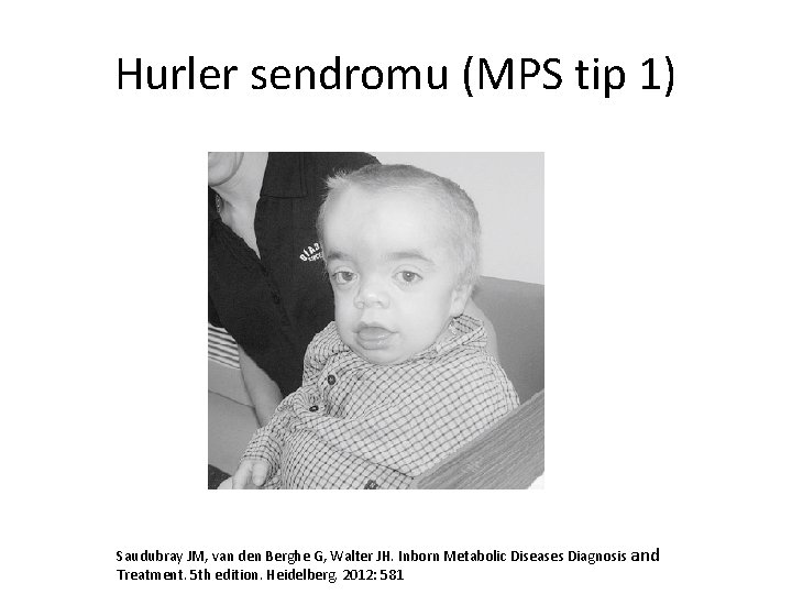 Hurler sendromu (MPS tip 1) Saudubray JM, van den Berghe G, Walter JH. Inborn