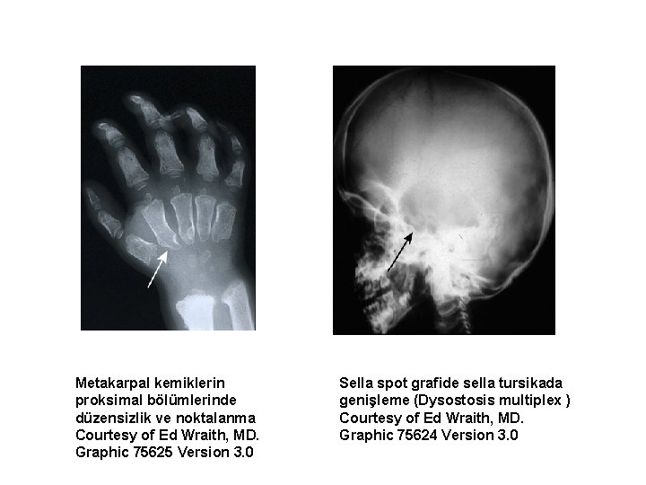 Metakarpal kemiklerin proksimal bölümlerinde düzensizlik ve noktalanma Courtesy of Ed Wraith, MD. Graphic 75625