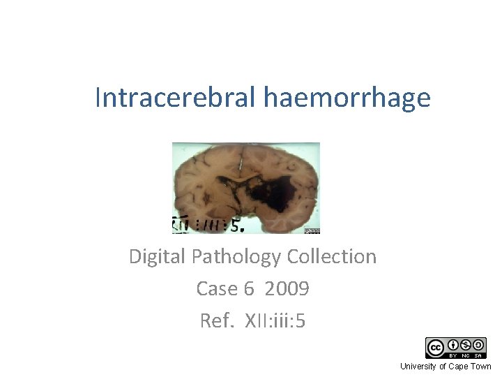 Intracerebral haemorrhage Digital Pathology Collection Case 6 2009 Ref. XII: iii: 5 University of