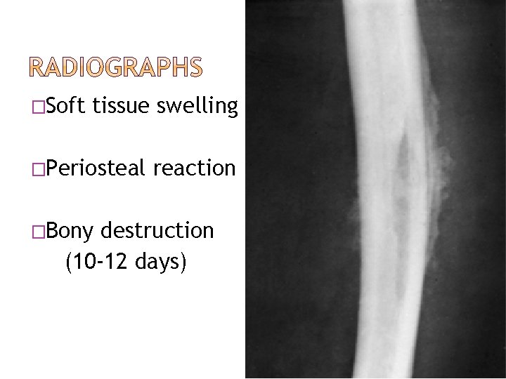 �Soft tissue swelling �Periosteal �Bony reaction destruction (10 -12 days) 