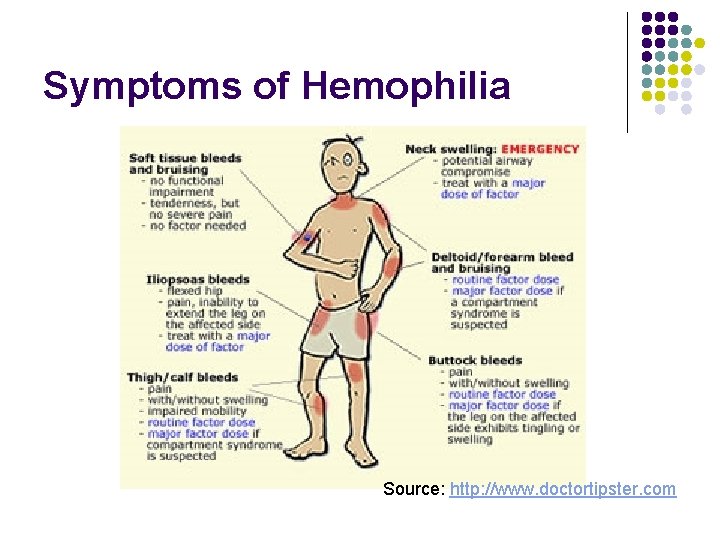 Symptoms of Hemophilia Source: http: //www. doctortipster. com Symptoms of Hemophilia Source: http: //www. doctortipster. com