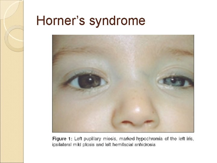 Horner’s syndrome 