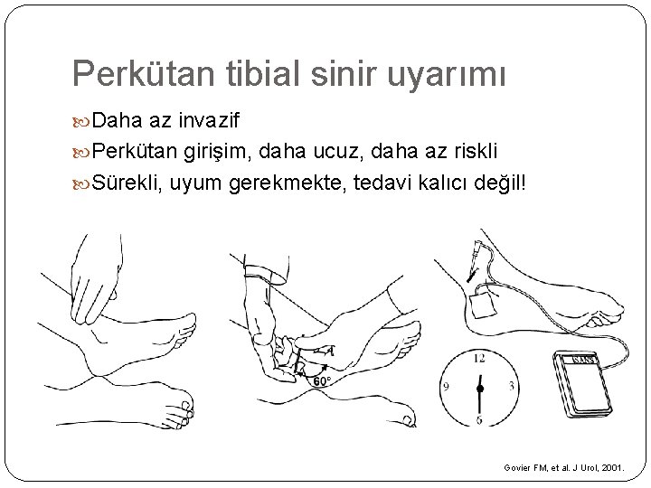Perkütan tibial sinir uyarımı Daha az invazif Perkütan girişim, daha ucuz, daha az riskli Perkütan tibial sinir uyarımı Daha az invazif Perkütan girişim, daha ucuz, daha az riskli
