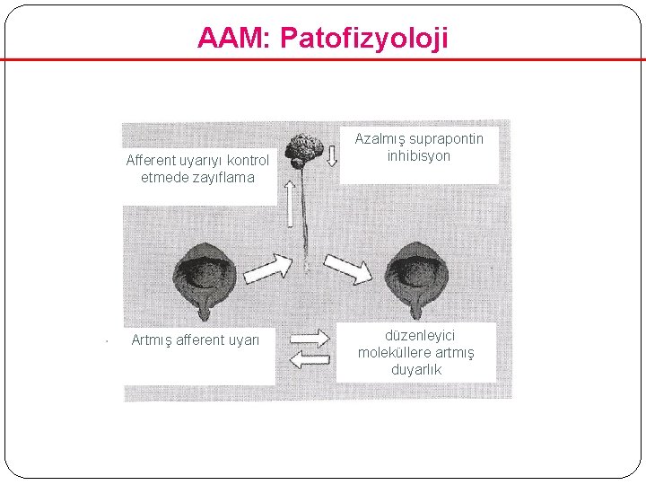 AAM: Patofizyoloji Afferent uyarıyı kontrol etmede zayıflama Artmış afferent uyarı Azalmış suprapontin inhibisyon düzenleyici