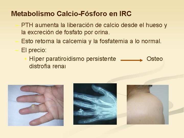 Metabolismo Calcio-Fósforo en IRC – PTH aumenta la liberación de calcio desde el hueso