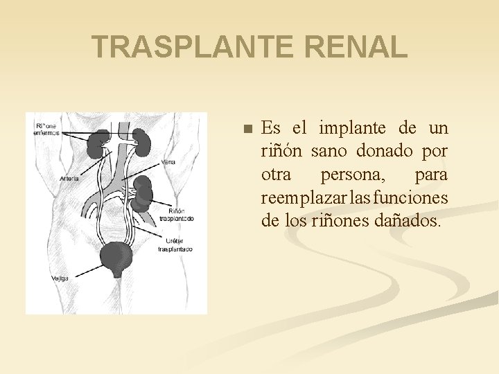 TRASPLANTE RENAL n Es el implante de un riñón sano donado por otra persona,