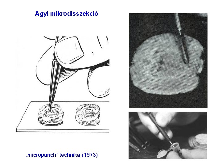 Agyi mikrodisszekció „micropunch” technika (1973) 