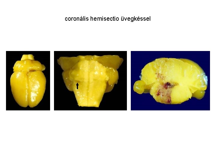 coronális hemisectio üvegkéssel 