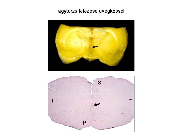 agytörzs felezése üvegkéssel S T T P agytörzs felezése üvegkéssel S T T P