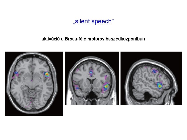 „silent speech” aktiváció a Broca-féle motoros beszédközpontban „silent speech” aktiváció a Broca-féle motoros beszédközpontban