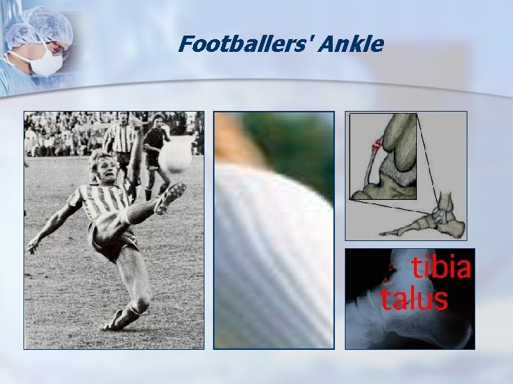 Footballers' Ankle 