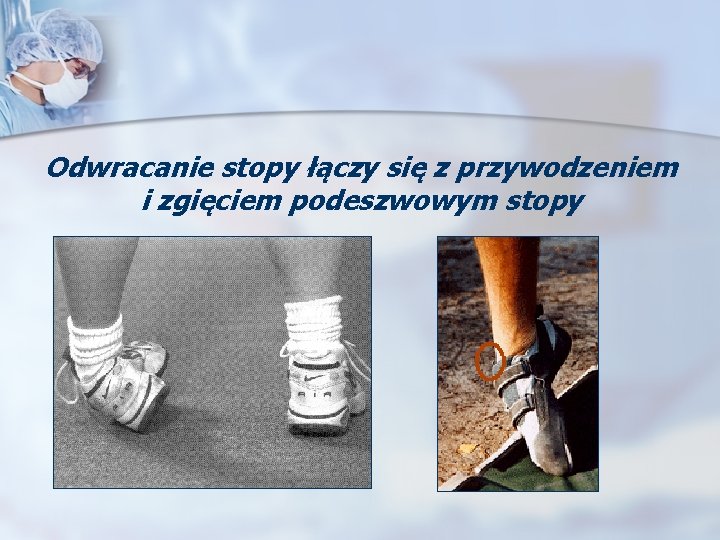 Odwracanie stopy łączy się z przywodzeniem i zgięciem podeszwowym stopy 